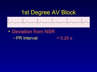 1st Degree AV Block
• Deviation from NSR
–PR Interval > 0.20 s
 