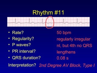 Rhythm #11
50 bpm• Rate?
• Regularity? regularly irregular
nl, but 4th no QRS
0.08 s
• P waves?
• PR interval? lengthens
• QRS duration?
Interpretation? 2nd Degree AV Block, Type I
 