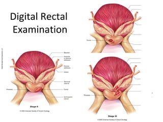X
                 X    Xxxx

Digital Rectal   X    X
                 X    Xx
                 Xx   X

Examination      X
                 X
                      X
                      X
                 X    X
                 X    X
                 X    X
                 X    X
                 X    X
                 X    X
                 X    X
                 X    X
                      X
                      X
                      X
                      X
                      X
                      X
 