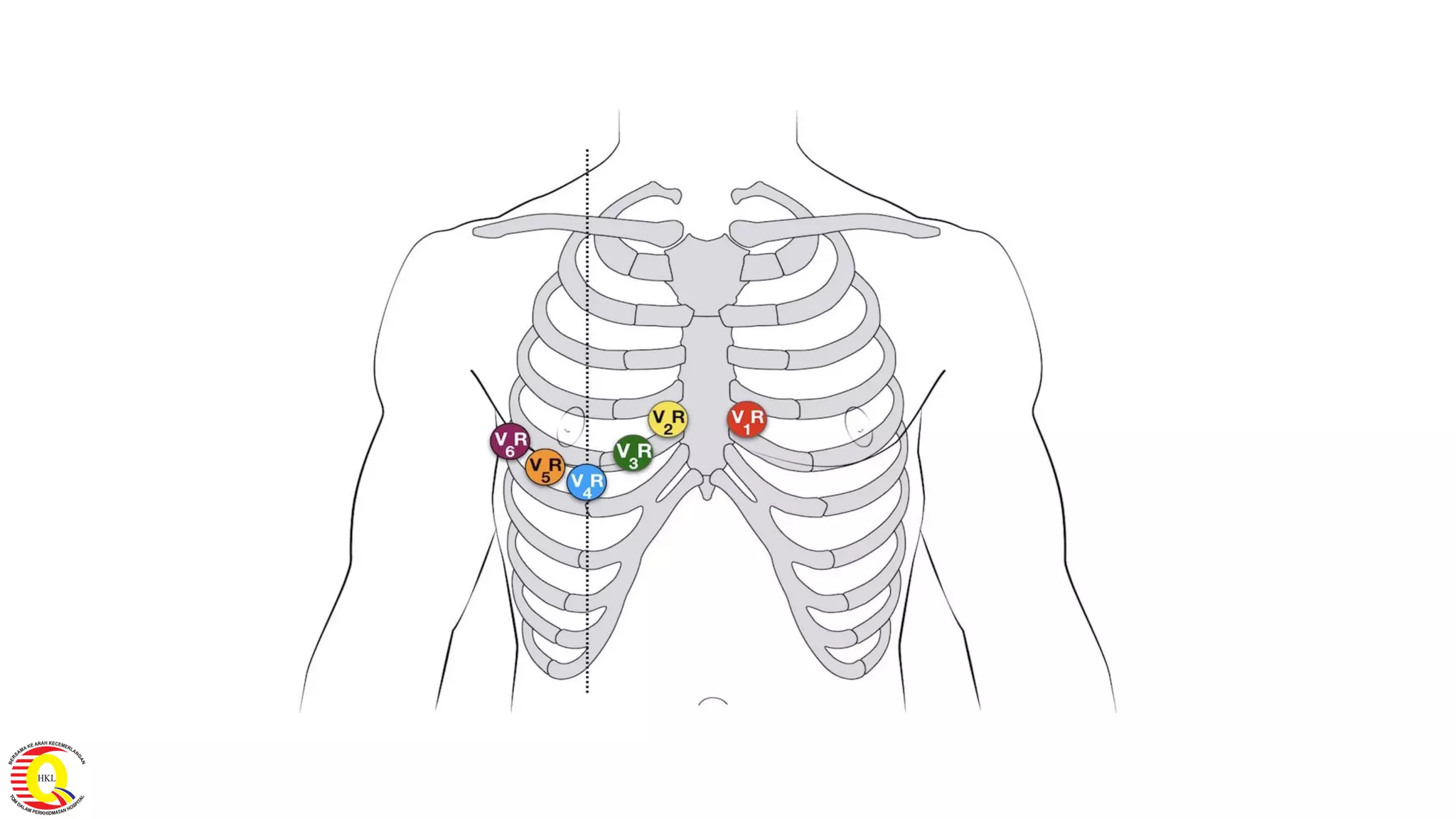 Module 5 tips and tricks- stemi ecg recognition & patterns finale | PDF