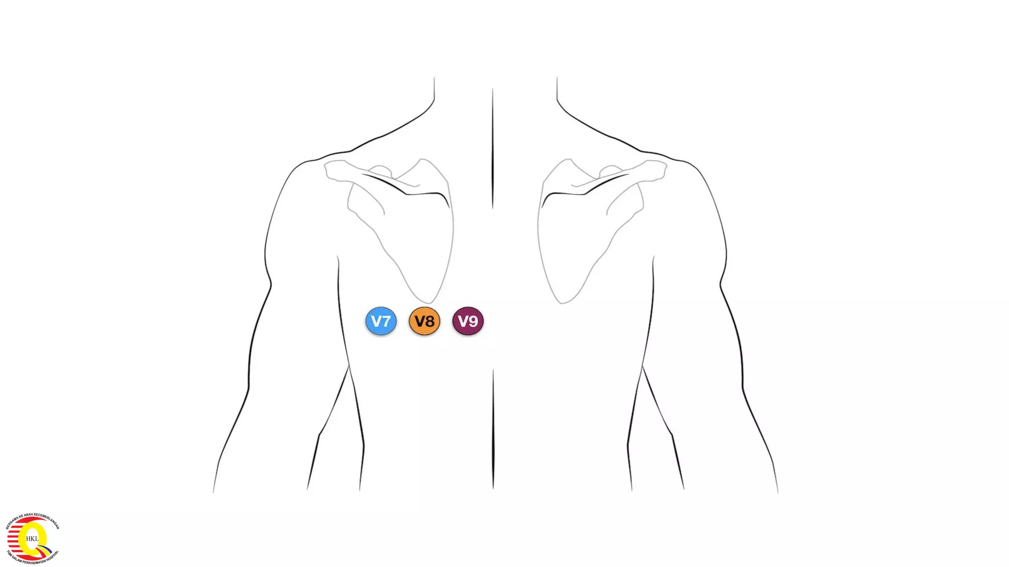 Module 5 tips and tricks- stemi ecg recognition & patterns finale | PDF