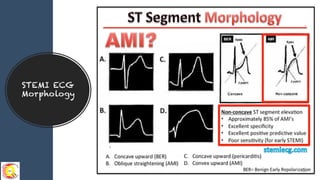 Module 5 tips and tricks- stemi ecg recognition & patterns finale | PDF