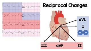 Module 5 tips and tricks- stemi ecg recognition & patterns finale | PDF