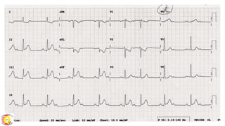 Module 5 tips and tricks- stemi ecg recognition & patterns finale | PDF