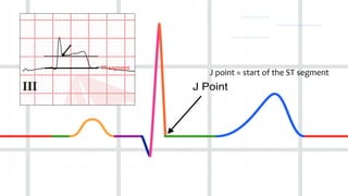 Module 5 tips and tricks- stemi ecg recognition & patterns finale | PDF