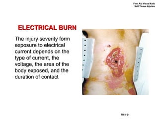 Module 5 first aid Soft Tissue Injury.ppt