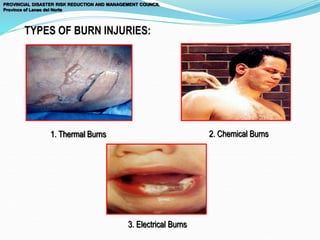 TYPES OF BURN INJURIES:
1. Thermal Burns 2. Chemical Burns
3. Electrical Burns
PROVINCIAL DISASTER RISK REDUCTION AND MANAGEMENT COUNCIL
Province of Lanao del Norte
 