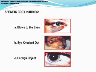 SPECIFIC BODY INJURIES:
a. Blows to the Eyes
b. Eye Knocked Out
c. Foreign Object
 