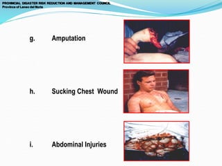 g. Amputation
h. Sucking Chest Wound
i. Abdominal Injuries
 