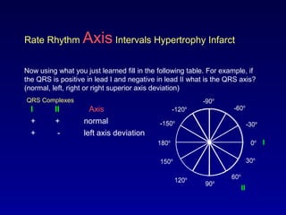 0o
30o
-30o
60o
-60o
-90o
-120o
90o120o
150o
180o
-150o
0o
30o
-30o
60o
-60o
-90o
-120o
90o120o
150o
180o
-150o
Rate Rhythm Axis Intervals Hypertrophy Infarct
Now using what you just learned fill in the following table. For example, if
the QRS is positive in lead I and negative in lead II what is the QRS axis?
(normal, left, right or right superior axis deviation)
QRS Complexes
I
AxisI II
+ +
+ -
normal
left axis deviation
II
 
