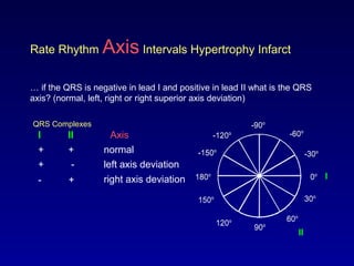 0o
30o
-30o
60o
-60o
-90o
-120o
90o120o
150o
180o
-150o
0o
30o
-30o
60o
-60o
-90o
-120o
90o120o
150o
180o
-150o
Rate Rhythm Axis Intervals Hypertrophy Infarct
… if the QRS is negative in lead I and positive in lead II what is the QRS
axis? (normal, left, right or right superior axis deviation)
QRS Complexes
I
AxisI II
+ +
+ -
- +
normal
left axis deviation
right axis deviation
II
 