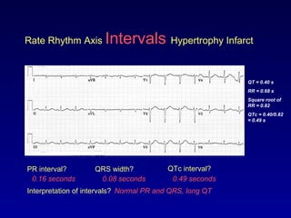 Rate Rhythm Axis Intervals Hypertrophy Infarct
PR interval? QRS width? QTc interval?
0.08 seconds0.16 seconds 0.49 seconds
QT = 0.40 s
RR = 0.68 s
Square root of
RR = 0.82
QTc = 0.40/0.82
= 0.49 s
Interpretation of intervals? Normal PR and QRS, long QT
 