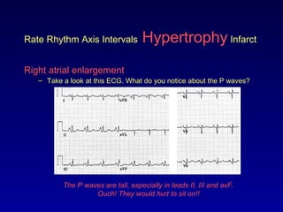Rate Rhythm Axis Intervals Hypertrophy Infarct
Right atrial enlargement
– Take a look at this ECG. What do you notice about the P waves?
The P waves are tall, especially in leads II, III and avF.
Ouch! They would hurt to sit on!!
 