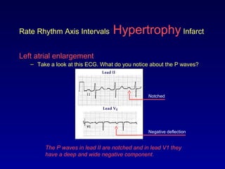 Rate Rhythm Axis Intervals Hypertrophy Infarct
Left atrial enlargement
– Take a look at this ECG. What do you notice about the P waves?
The P waves in lead II are notched and in lead V1 they
have a deep and wide negative component.
Notched
Negative deflection
 