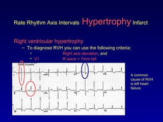Rate Rhythm Axis Intervals Hypertrophy Infarct
Right ventricular hypertrophy
– To diagnose RVH you can use the following criteria:
• Right axis deviation, and
• V1 R wave > 7mm tall
A common
cause of RVH
is left heart
failure.
 
