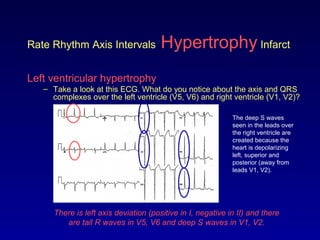 Rate Rhythm Axis Intervals Hypertrophy Infarct
Left ventricular hypertrophy
– Take a look at this ECG. What do you notice about the axis and QRS
complexes over the left ventricle (V5, V6) and right ventricle (V1, V2)?
There is left axis deviation (positive in I, negative in II) and there
are tall R waves in V5, V6 and deep S waves in V1, V2.
The deep S waves
seen in the leads over
the right ventricle are
created because the
heart is depolarizing
left, superior and
posterior (away from
leads V1, V2).
 