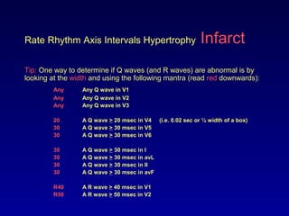Rate Rhythm Axis Intervals Hypertrophy Infarct
Tip: One way to determine if Q waves (and R waves) are abnormal is by
looking at the width and using the following mantra (read red downwards):
Any Any Q wave in V1
Any Any Q wave in V2
Any Any Q wave in V3
20 A Q wave > 20 msec in V4 (i.e. 0.02 sec or ½ width of a box)
30 A Q wave > 30 msec in V5
30 A Q wave > 30 msec in V6
30 A Q wave > 30 msec in I
30 A Q wave > 30 msec in avL
30 A Q wave > 30 msec in II
30 A Q wave > 30 msec in avF
R40 A R wave > 40 msec in V1
R50 A R wave > 50 msec in V2
 