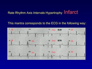 Rate Rhythm Axis Intervals Hypertrophy Infarct
This mantra corresponds to the ECG in the following way:
Any
Any
Any
20
30
30
30
3030
30
R40
R50
 