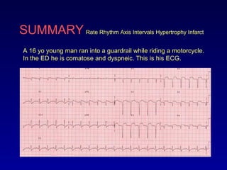 SUMMARY Rate Rhythm Axis Intervals Hypertrophy Infarct
A 16 yo young man ran into a guardrail while riding a motorcycle.
In the ED he is comatose and dyspneic. This is his ECG.
 