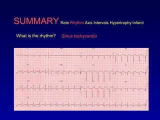 SUMMARY Rate Rhythm Axis Intervals Hypertrophy Infarct
What is the rhythm? Sinus tachycardia
 