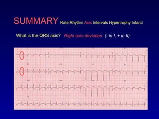SUMMARY Rate Rhythm Axis Intervals Hypertrophy Infarct
What is the QRS axis? Right axis deviation (- in I, + in II)
 