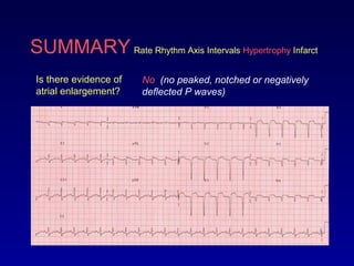 SUMMARY Rate Rhythm Axis Intervals Hypertrophy Infarct
Is there evidence of
atrial enlargement?
No (no peaked, notched or negatively
deflected P waves)
 