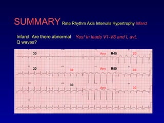SUMMARY Rate Rhythm Axis Intervals Hypertrophy Infarct
Infarct: Are there abnormal
Q waves?
Yes! In leads V1-V6 and I, avL
Any
Any
Any
20
30
30
30
3030
30
R40
R50
 
