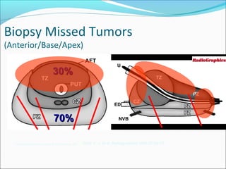 Biopsy Missed Tumors
(Anterior/Base/Apex)

                                  30%



                                   70%

  Copyright ©Radiological Society of North America, 2007   Choi, Y. J. et al. Radiographics 2007;27:63-75
 