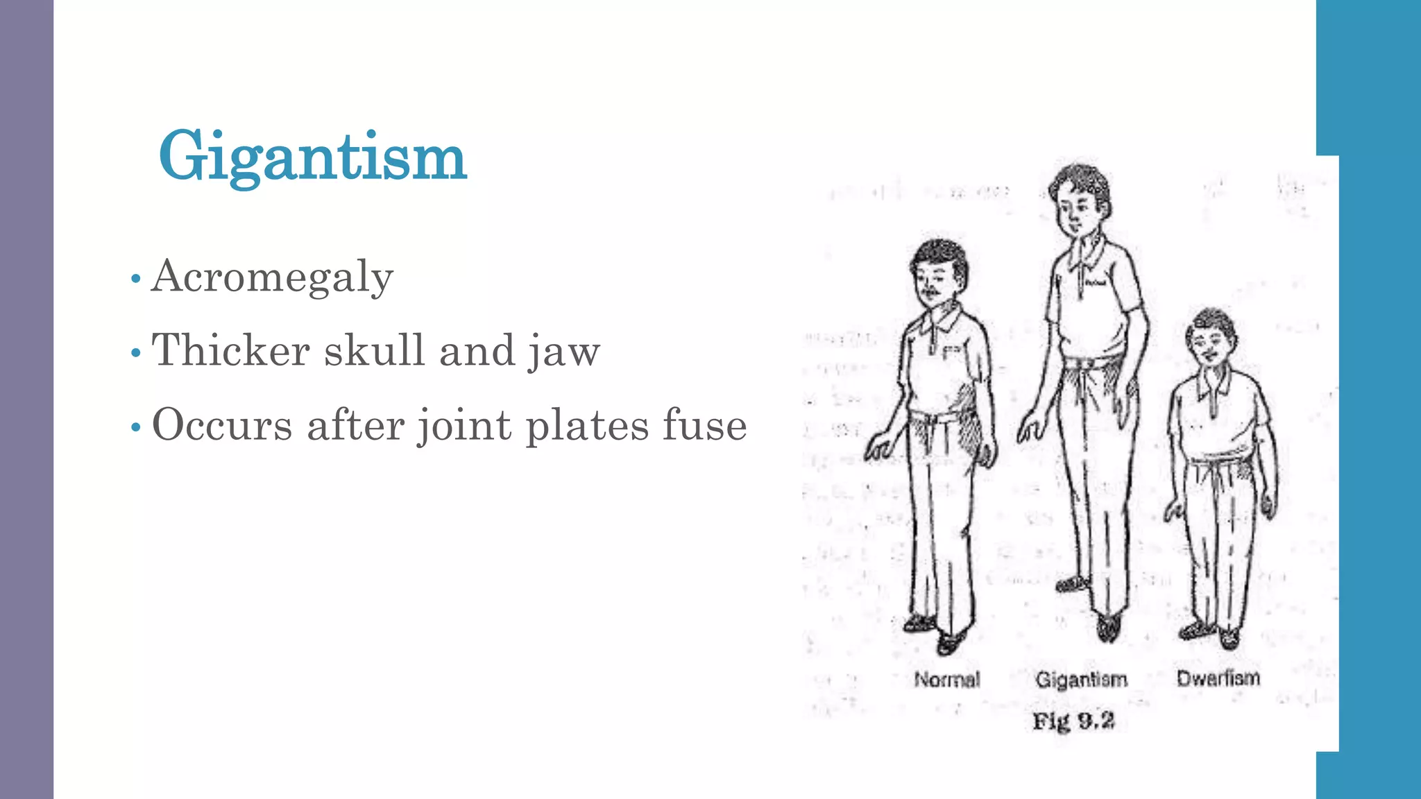Gigantism
• Acromegaly
• Thicker skull and jaw
• Occurs after joint plates fuse
 