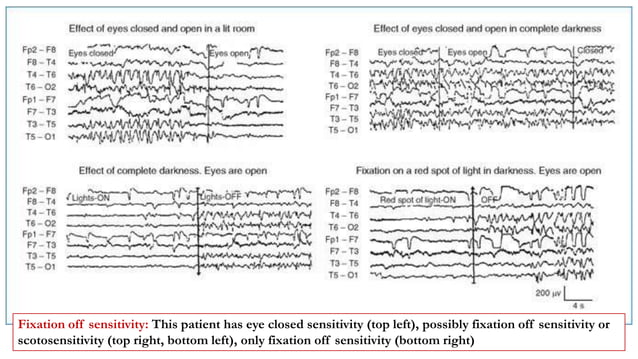 Activation Proceedures in EEG.pptx | Eye and Vision Conditions ...