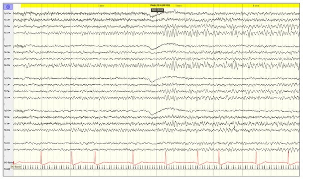 Activation Proceedures in EEG.pptx | Eye and Vision Conditions ...