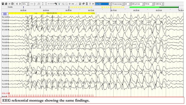 Activation Proceedures in EEG.pptx | Eye and Vision Conditions ...