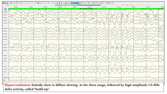 Activation Proceedures in EEG.pptx | Eye and Vision Conditions ...