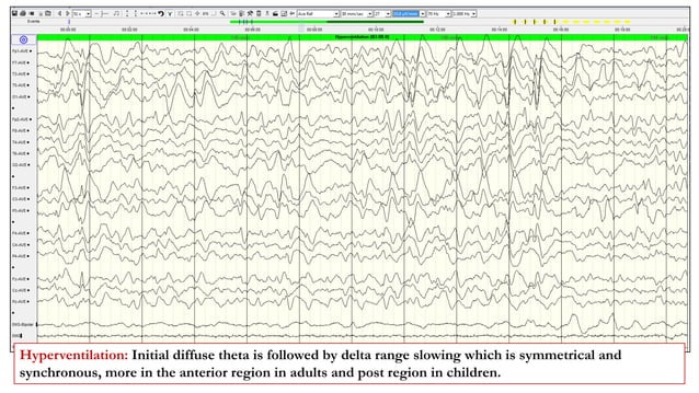Activation Proceedures in EEG.pptx | Eye and Vision Conditions ...