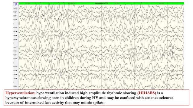 Activation Proceedures in EEG.pptx | Eye and Vision Conditions ...