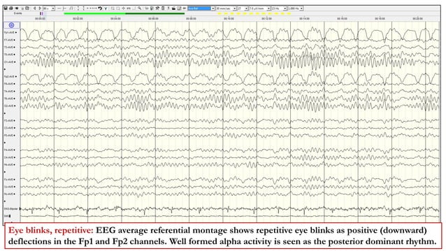 Artifacts in EEG.pptx | Eye and Vision Conditions | Diseases and Conditions