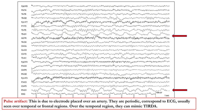 Artifacts in EEG.pptx | Eye and Vision Conditions | Diseases and Conditions