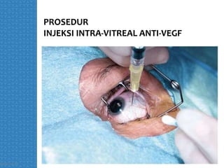 Module injeksi intravitreal.pptx