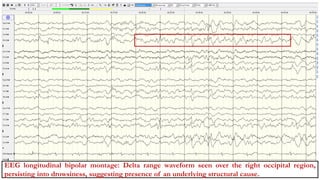 Eeg Wave Form Ranges Non epileptiform variants in EEG.pptx