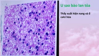 U sao bào lan tỏa
Thấy xuất hiện nang và ổ
calci hóa
 