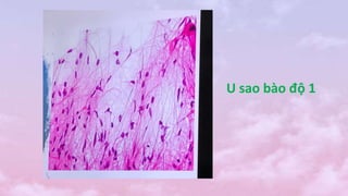U sao bào độ 1
 