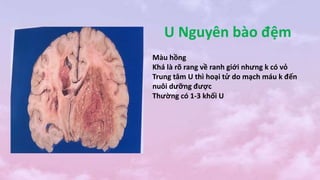U Nguyên bào đệm
Màu hồng
Khá là rõ rang về ranh giới nhưng k có vỏ
Trung tâm U thì hoại tử do mạch máu k đến
nuôi dưỡng được
Thường có 1-3 khối U
 