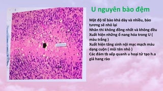 U nguyên bào đệm
Mật độ tế bào khá dày và nhiều, bào
tương sẽ nhỏ lại
Nhân thì không đồng nhất và không đều
Xuất hiện những ổ nang hóa trong U (
màu trắng )
Xuất hiện tăng sinh nội mạc mạch máu
dạng cuộn ( mũi tên nhỏ )
Các đám tb xếp quanh u hoại tử tạo h.a
giả hang rào
 