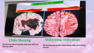 Chấn thương Nhiễm trùng, nhiễm khuẩn
Tổn thương thành từng đám chảy máu, khối máu
Chèn ép mạnh
Tổn thương dạng lan tỏa, thành những chấm nốt và không
chèn ép
 