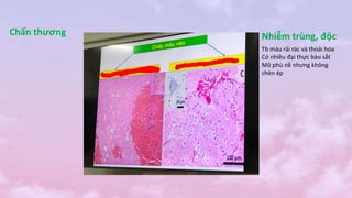 Chấn thương Nhiễm trùng, độc
Tb máu rải rác và thoái hóa
Có nhiều đại thực bào sắt
Mô phù nề nhưng không
chèn ép
 