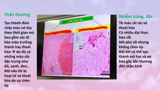 Chấn thương Nhiễm trùng, độc
Tb máu rải rác và
thoái hóa
Có nhiều đại thực
bào sắt
Mô phù nề nhưng
không chèn ép
Đôi khi có thể tạo
thành mô hạt và xơ
hóa gây tổn thương
đến thần kinh
Tạo thành đám
chảy máu nó tùy
theo thời gian mà
bao gồm các tế
bào máu trưởng
thành hay thoái
hóa  do đó có
những màu sắc
đặc trưng như
đỏ, xanh, đen..
Mô não thì bị
hoại tử và thoái
hóa do sự chèn
ép
 