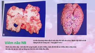 Viêm não NB
Là tổn thương viêm cấp ở mô não chủ yếu do virus. Bệnh cấp tính và db
nặng tỷ lệ tử vong cao – hay gặp ở trẻ e
Hình của viêm cấp : mô não thì sung huyết, có phù nhiều, mặt cắt thì đỏ và nhiều đám chảy máu
Do vậy mà áp lực nội sọ tăng cao làm bn cảm thấy đau đầu
 