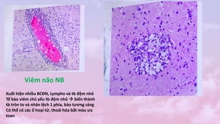 Viêm não NB
Xuất hiện nhiều BCĐN, Lympho và tb đệm nhỏ
Tế bào viêm chủ yếu tb đệm nhỏ  biến thành
tb tròn to và nhân lệch 1 phía, bào tương sáng
Có thể có các ổ hoại tử, thoái hóa bắt màu ưa
toan
 
