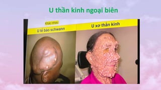 U thần kinh ngoại biên
 