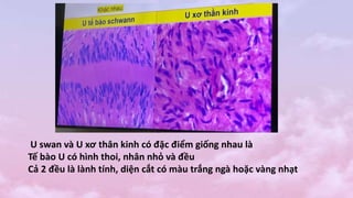 U swan và U xơ thân kinh có đặc điểm giống nhau là
Tế bào U có hình thoi, nhân nhỏ và đều
Cả 2 đều là lành tính, diện cắt có màu trắng ngà hoặc vàng nhạt
 